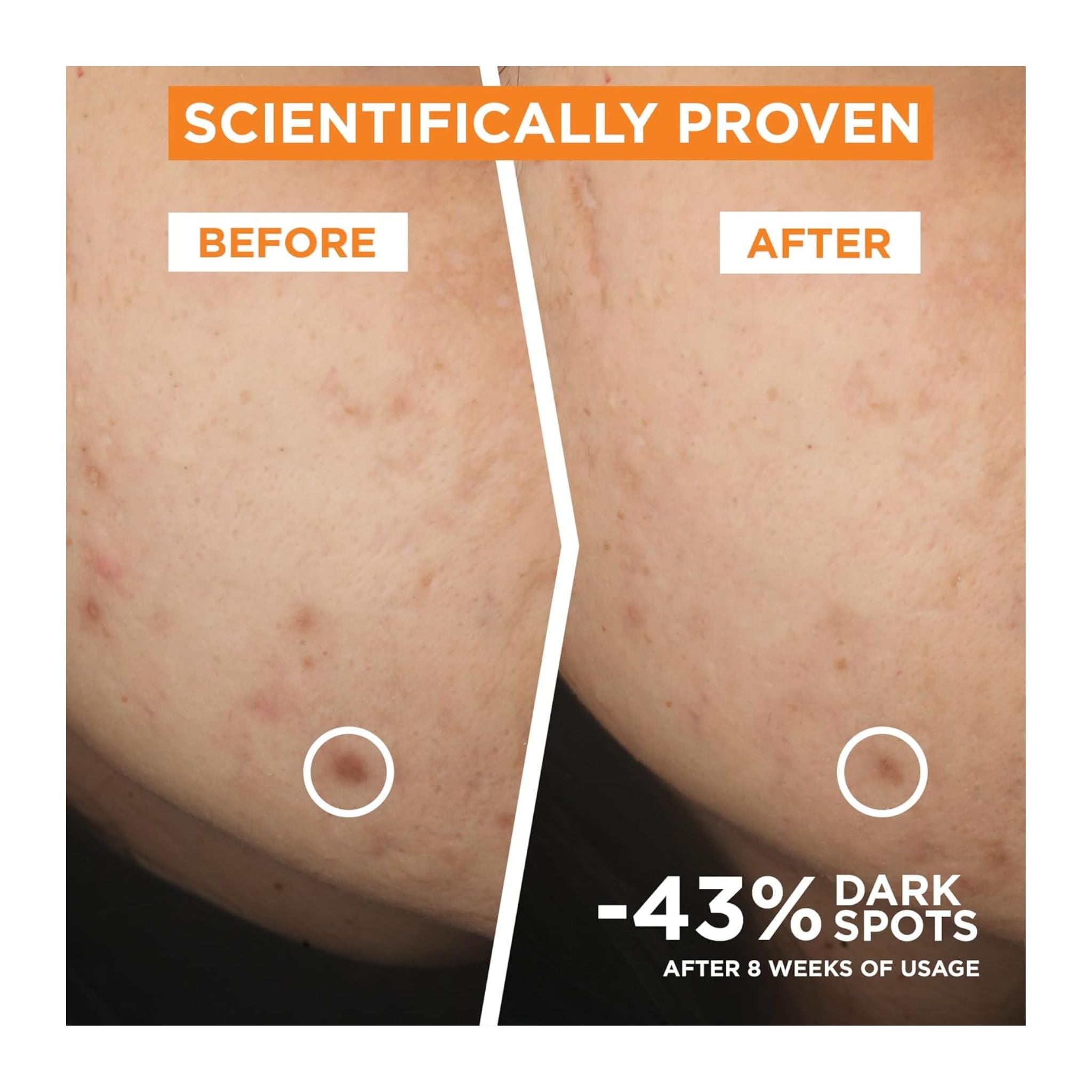 Before and after comparison of skin with dark spots reduction, scientifically proven.